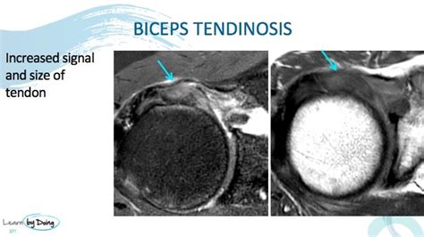 imaging to confirm biceps tendonitis